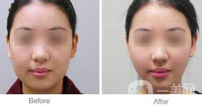 面部光纖溶脂好嗎？價(jià)格是多少