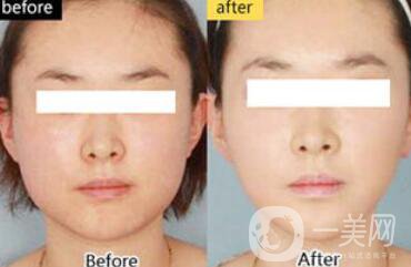 面部光纖溶脂好嗎？價(jià)格是多少