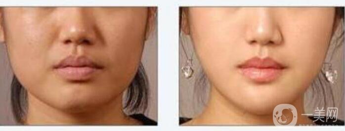 上海自體脂肪隆下巴費(fèi)用,自體脂肪隆下巴注意事項(xiàng)