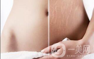 果酸換膚,去妊娠紋,果酸換膚去妊娠紋禁忌人群,果酸換膚去妊娠紋注意事項