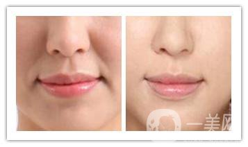 深圳手術(shù)去法令紋價格大概是多少