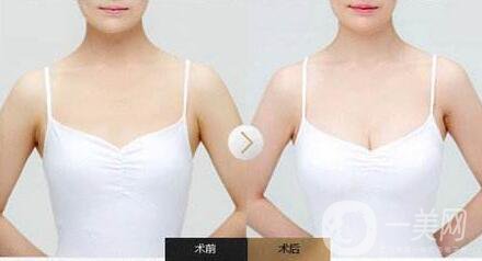 隆胸后怎么護(hù)理？術(shù)前怎么準(zhǔn)備？