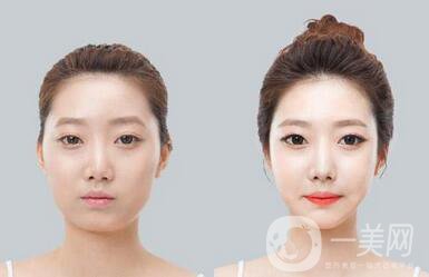 玻尿酸豐太陽穴*果好嗎