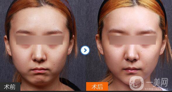 北京膨體墊下巴多少錢,膨體墊下巴注意事項(xiàng)