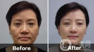 汕頭電波拉皮除皺多少錢(qián)