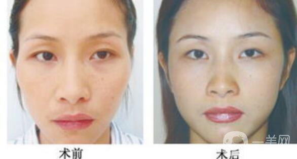 假體豐太陽穴,假體豐太陽穴危害