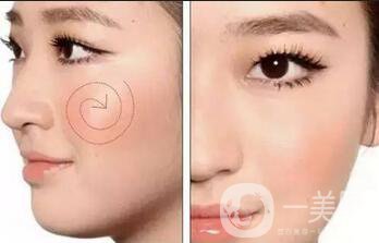 玻尿酸豐蘋果肌術(shù)后多久*果自然
