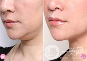 快速去除雙下巴方法是什么