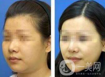 快速去除雙下巴方法是什么