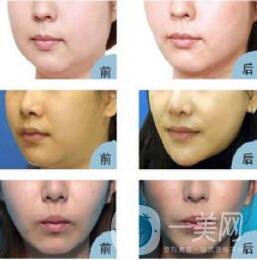 快速去除雙下巴方法是什么