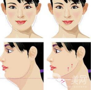 怎么去掉雙下巴？溶脂去雙下巴怎么樣