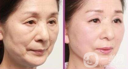 拉皮除皺能堅(jiān)持幾年？與哪些因素有關(guān)？