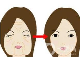 拉皮除皺能堅(jiān)持幾年？與哪些因素有關(guān)？