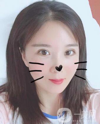 全開雙眼皮和開眼角