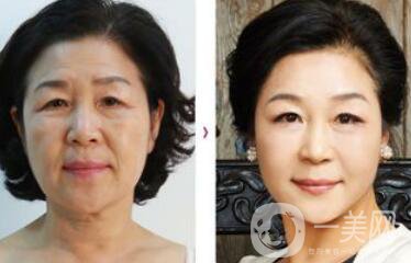 拉皮能維持多久？拉皮的價(jià)格是多少