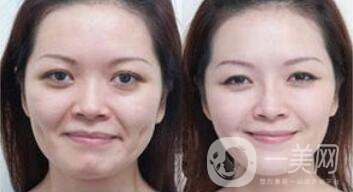 拉皮能維持多久？拉皮的價(jià)格是多少