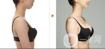 假體隆胸材料有哪些？*果怎么樣