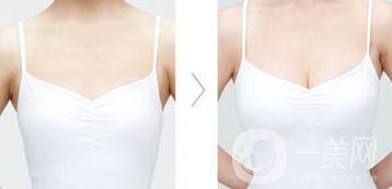 假體隆胸材料有哪些？*果怎么樣