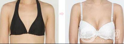 假體隆胸材料有哪些？*果怎么樣