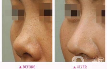 朝天鼻矯正多少錢(qián)