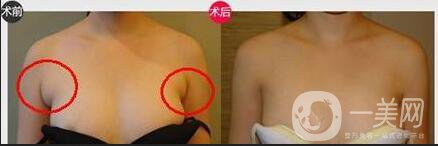 副乳祛除價格,副乳祛除術(shù)后護理