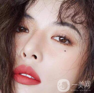 玻尿酸去眉間紋多少錢及術(shù)后護(hù)理