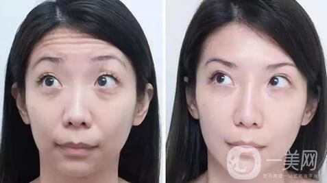 玻尿酸去眉間紋多少錢及術(shù)后護(hù)理