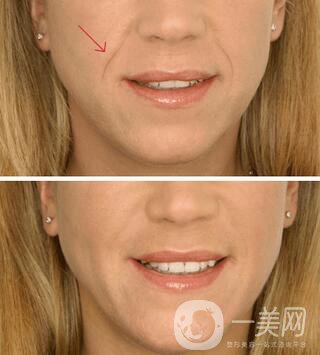 上海自體脂肪填充法令紋多少錢？