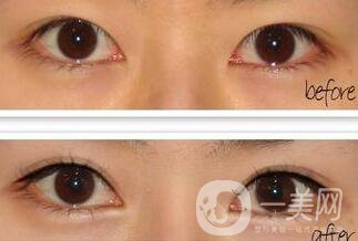 北京超聲波乳化去眼袋價格,超聲波去眼袋價格