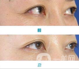 玻尿酸去魚尾紋優(yōu)缺點(diǎn),玻尿酸去魚尾紋價(jià)格