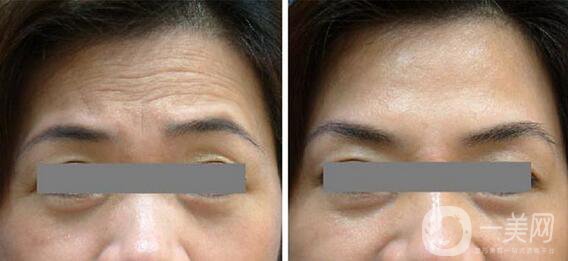 深圳做熱瑪吉多少錢及術(shù)后護(hù)理介紹