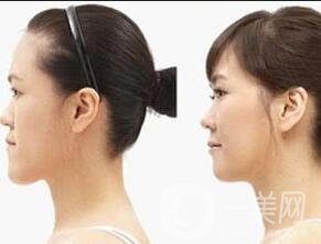 上海地包天矯正多少錢,地包天矯正注意事項