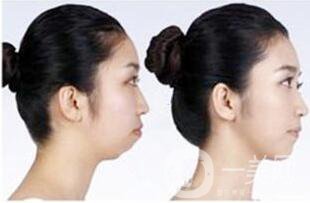 上海正頜手術(shù)多少錢,正頜手術(shù)術(shù)后護(hù)理