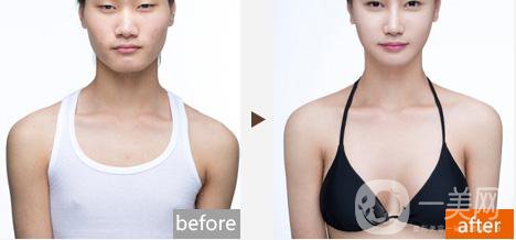 做假體豐胸手術(shù)影響生育嗎