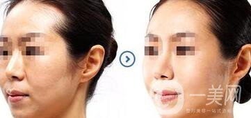 江蘇微波拉皮價(jià)格是多少