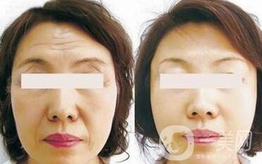 電波拉皮*果怎么樣呢？價格高嗎