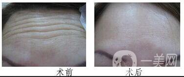 廣東祛抬頭紋多少錢(qián),祛抬頭紋注意事項(xiàng)