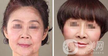 南京熱瑪吉除皺多少錢