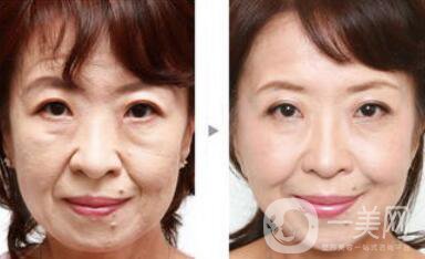 南京熱瑪吉除皺多少錢