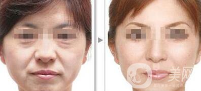 南京熱瑪吉除皺多少錢