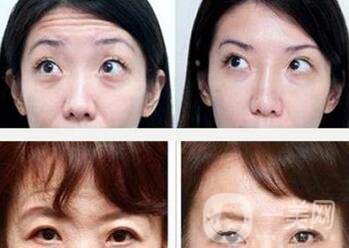 玻尿酸去抬頭紋*果好嗎