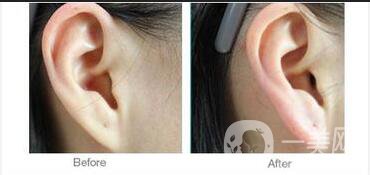 廣東自體脂肪豐耳垂多少錢,自體脂肪豐耳垂注意事項