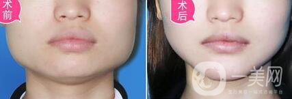 頜骨矯正術(shù)后護(hù)理方法有哪些