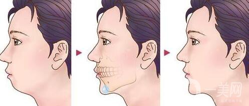 頜骨矯正術(shù)后護(hù)理方法有哪些