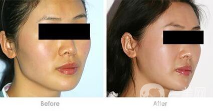 頜骨矯正術(shù)后護(hù)理方法有哪些