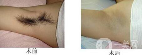 絕緣微針脫毛有用嗎