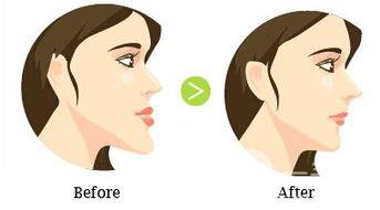 廣東矯正天包地牙價格大概是多少