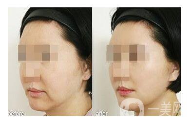 做熱瑪吉多少錢 熱瑪吉美膚價(jià)格貴不貴