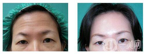 *去抬頭紋注意事項 術(shù)后要怎么護理