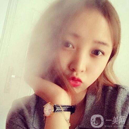 玻尿酸去魚尾紋價格 去魚尾紋費用多少錢